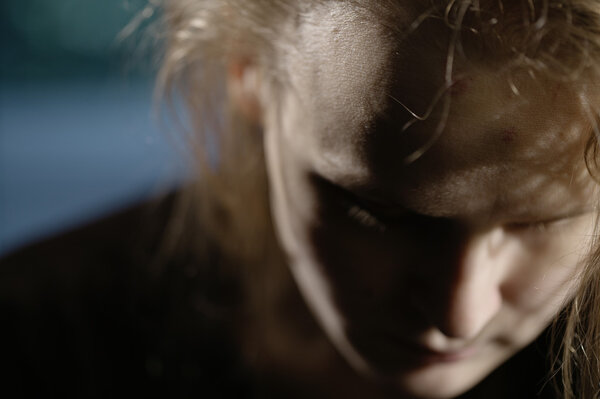 Bruises on forehead. Domestic violence