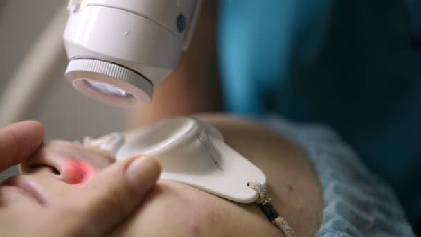 Макро-снимок лазерного лечения кожи — стоковое видео