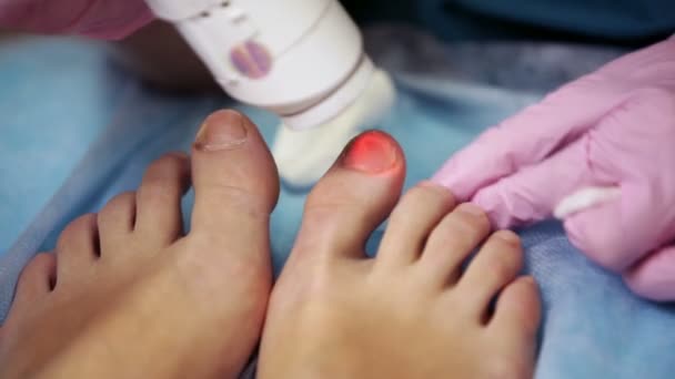 足病医レーザーを用いた爪真菌症を治療 — ストック動画