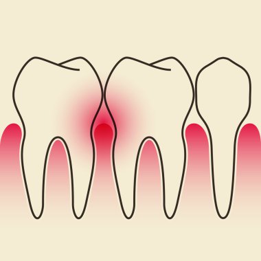 Periodontal Hastalık