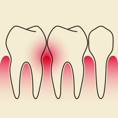 Periodontal Disease clipart