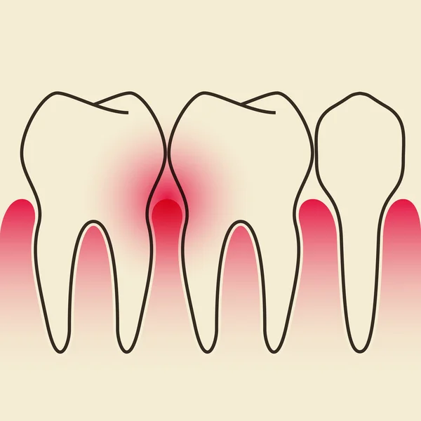 Enfermedad periodontal — Archivo Imágenes Vectoriales