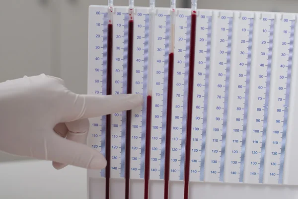 Woman doctor doing erythrocyte sedimentation rate test — Stock Photo, Image