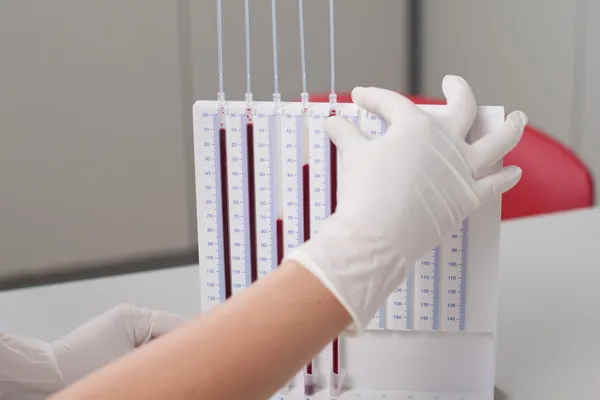Женщина-врач делает тест на отложения эритроцитов — стоковое фото