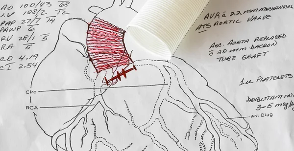 Diagrama de cirugía cardíaca de un cirujano cardíaco — Foto de Stock