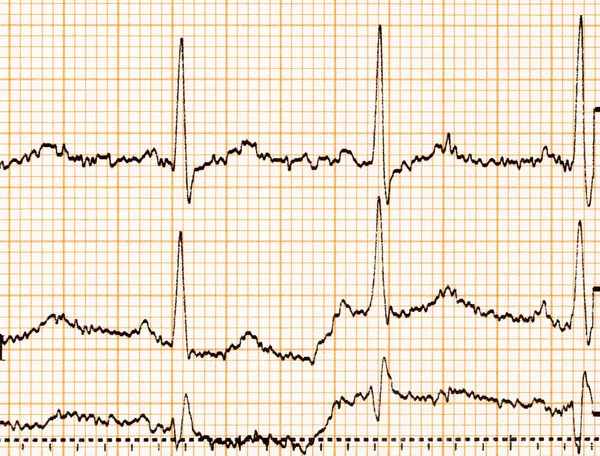 Papel de ecg — Fotografia de Stock