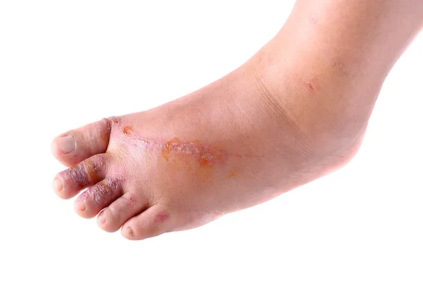 Wounds on women foot — Stock Photo, Image