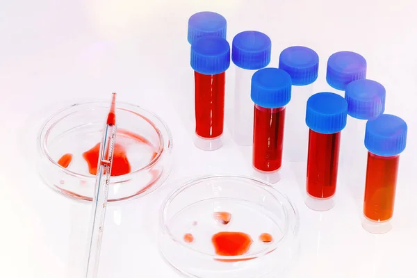 Образец коронавируса COVID-19. Чашка Петри и пробирки с кровью в лаборатории. Кровавый коронавирус тестируется, разрабатывается вакцина.. — стоковое фото