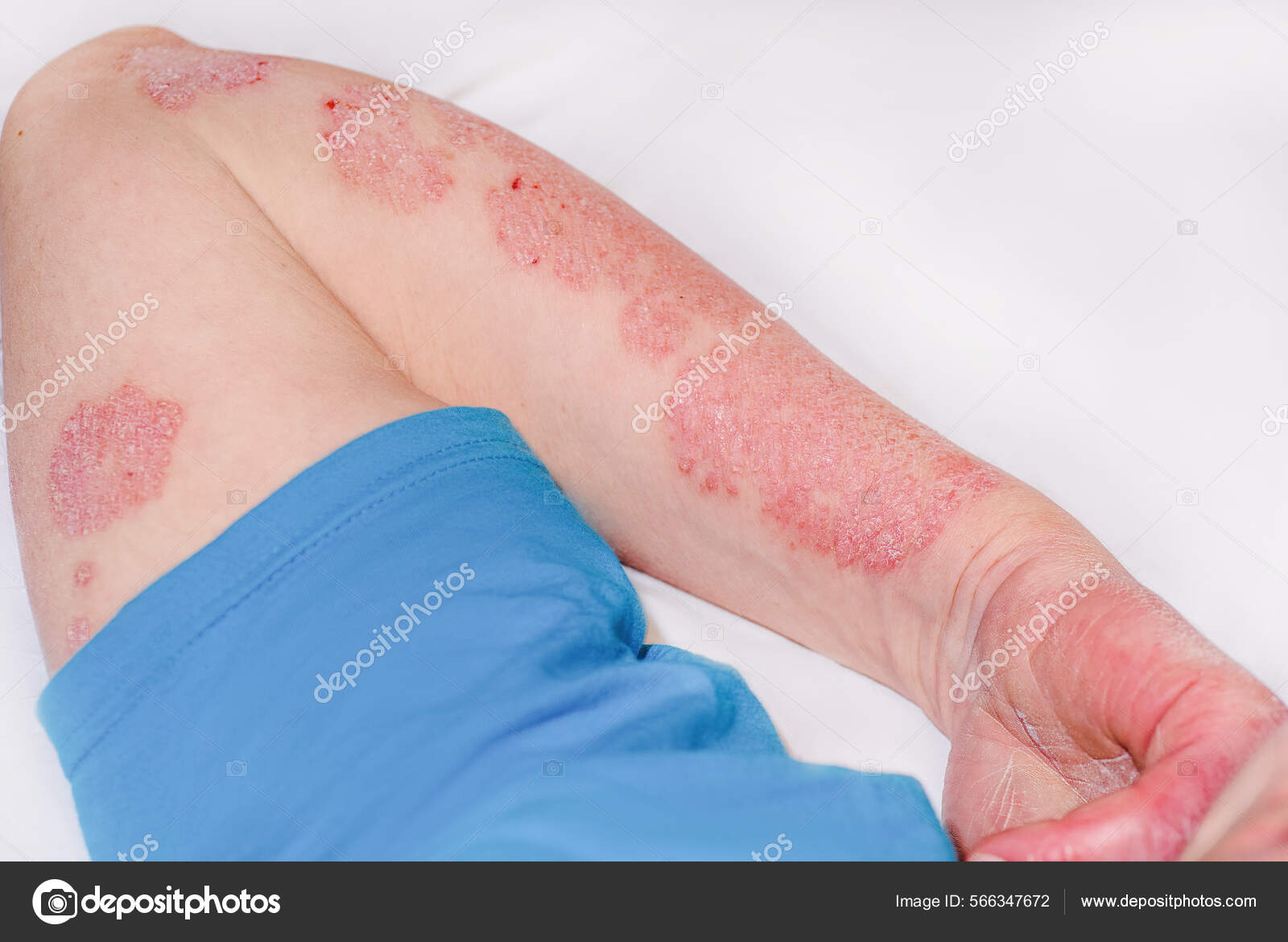 Braco Psoriase