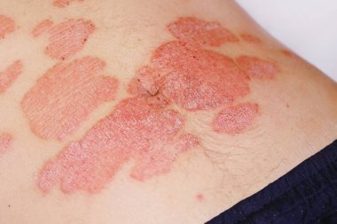 Karnında büyük kırmızı, iltihaplı, pullu kızarıklık var. Bir adamın midesinde akut sedef hastalığı cildinde kızarıklık, otoimmün, tedavisi olmayan dermatolojik deri hastalığı. Kızarıklık, ciltte lekeler..