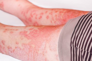 Büyük kırmızı, iltihaplı, erkek bacağında pullu kızarıklık. Akut sedef hastalığı, ciltte şiddetli kızarıklık, otoimmün, tedavisi olmayan cilt hastalığı. Kırmızı kızarıklık, ciltte lekeler..