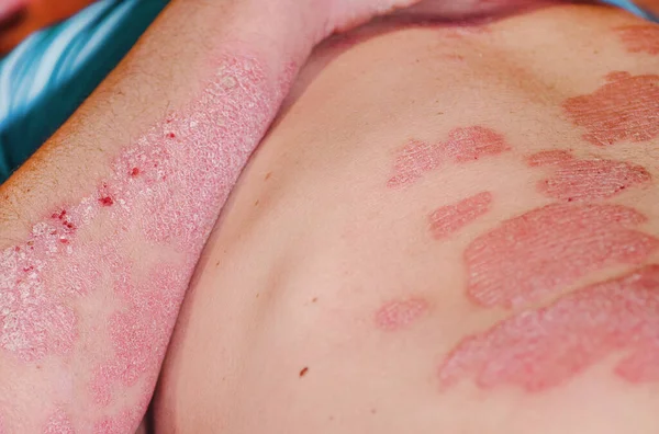 Large red inflamed scaly rash on the body of a man. Acute psoriasis in a man, severe redness on the skin, an autoimmune incurable dermatological skin disease. Red redness, spots on the skin.