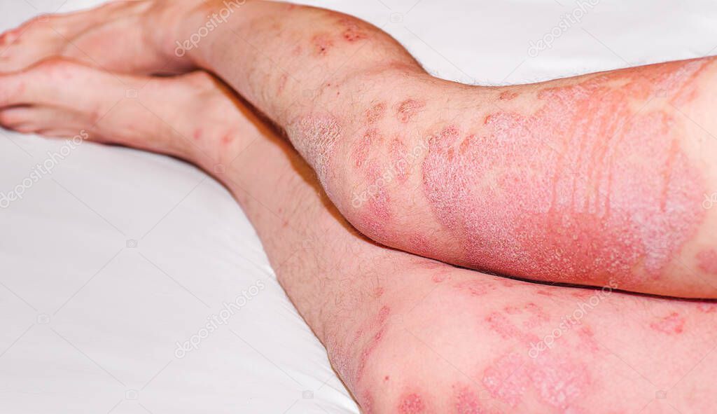 Large red,inflamed,scaly rash on mans legs.Acute psoriasis, severe reddening of the skin,an autoimmune,incurable dermatological skin disease.Joints affected by psoriatic arthritis.