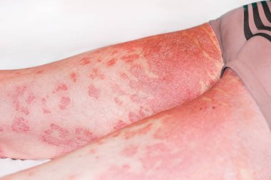 Akut sedef hastalığı, ciltte kızarıklık, otoimmün, tedavisi olmayan dermatolojik deri hastalığı. Ciltte kırmızı lekeler. Sedef hastalığından etkilenmiş eklemler. Büyük iltihaplı, erkek bacağında pullu kızarıklık..