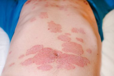 Bir adamın midesinde akut sedef hastalığı cildinde kızarıklık, otoimmün, tedavisi olmayan dermatolojik deri hastalığı. Kırmızı kızarıklık, deride lekeler. Midede büyük kırmızı iltihaplı kızarıklık..