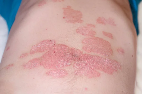 Red redness, spots on the skin.Large red inflamed scaly rash on the stomach.Acute psoriasis on the stomach in a man, severe redness on the skin, an autoimmune incurable dermatological skin disease.