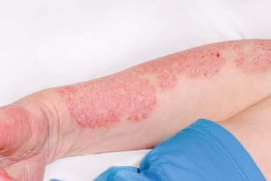 Bir adamın kolunda akut sedef hastalığı, cildinde şiddetli kızarıklık, tedavisi olmayan bir otoimmün cilt hastalığı. Kırmızı kızarıklık, ciltte lekeler. Ellerinde büyük kırmızı, iltihaplı kızarıklık..