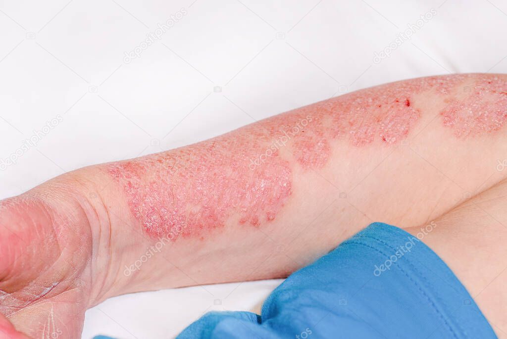 Acute psoriasis on the arm of a man, severe redness on the skin, an autoimmune incurable dermatological skin disease. Red redness, spots on the skin.Large red inflamed scaly rash on the hands.