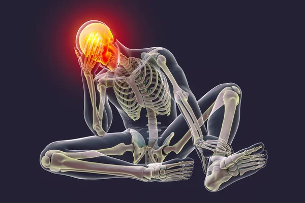 Fejfájás Számítógépes Illusztráció Egy Férfi Test Csontvázzal Fájdalommal Fején Vörös — Stock Fotó