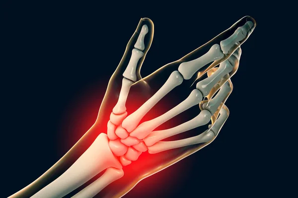 Illustration Painful Wrist — Stock Photo, Image