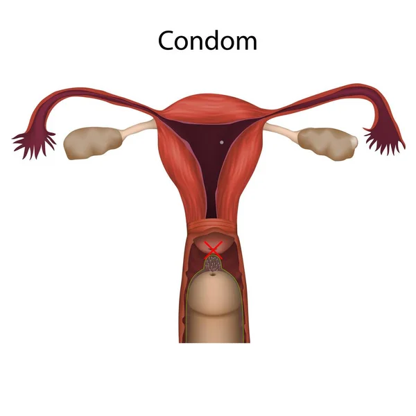 Condom Contraception Mechanism Action Illustration — Stock Photo, Image