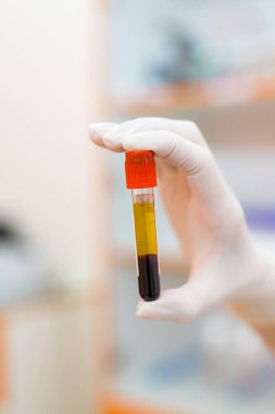 Tüp içinde tıbbi kan testi. Test tüpünde kan tutan el..