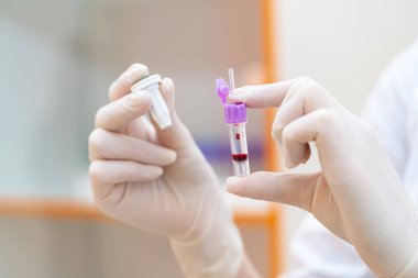 Modern hastanede laboratuvar bilimsel analizi. Kan testi örnekleri ellerinde..