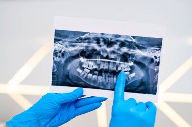 Diş sağlığı röntgeni tedavisi. Diş Hekimliği X-ray Resim İncelemesi.