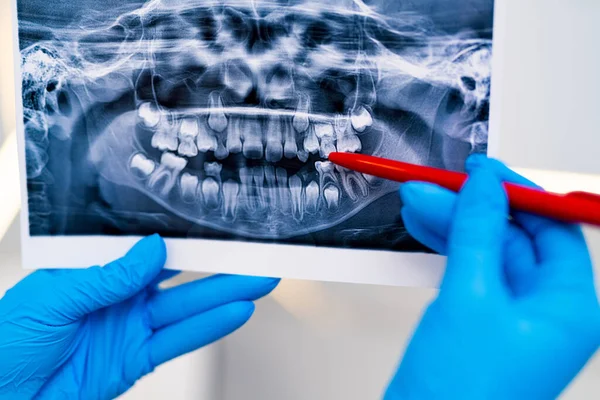 Tandheelkunde Röntgenfoto Onderzoek Tanden Gezondheidszorg Röntgenbehandeling — Stockfoto