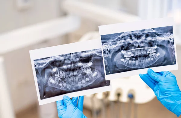 Stomatologie Tanden Analyseren Röntgenfoto Van Tanden Handen Houden — Stockfoto