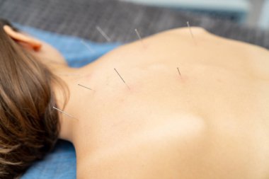 Profesyonel spa iğne terapisi. İğne sırtı prosedürü.