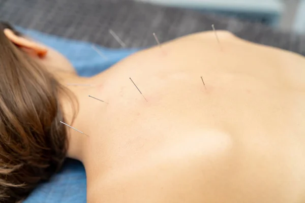 Professional spa needle therapy. Needles back procedure.