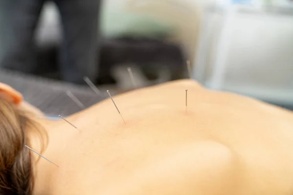 Needles back procedure. Professional spa needle therapy.