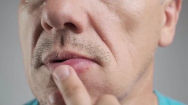 Arı sokmasına alerjik reaksiyon. Tıraşsız bir adam bir arı tarafından sokuldu ve yüzüne yakından dokundu. Ödem, alt dudağında şişkinlik.