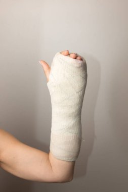 Kırık eli ve bileği alçıya alınmış bir kadın.