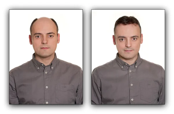 Homem careca com uma Perna . — Fotografia de Stock