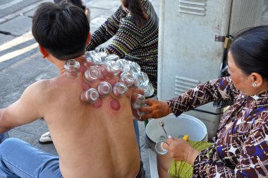 hombre recibe un tratamiento de cuping, una terapia de medicina alternativa China