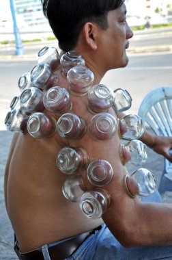 hombre recibe un tratamiento de cuping, una terapia de medicina alternativa China