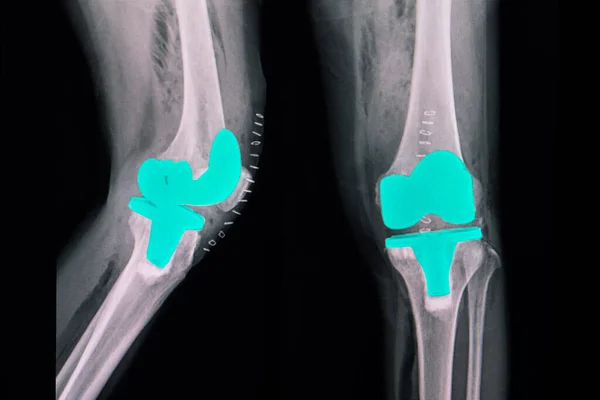 Radiografía Paciente Tras Cirugía Total Reemplazo Rodilla Con Prótesis Metálica — Foto de Stock