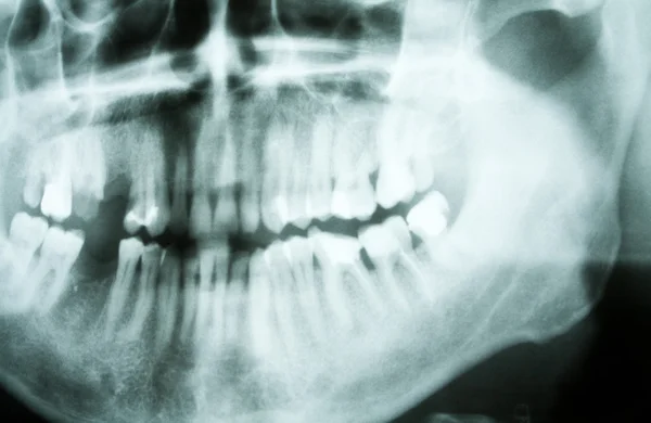 歯科用 x 線 — ストック写真