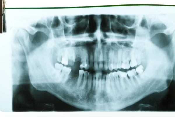 RTG stomatologiczne — Zdjęcie stockowe