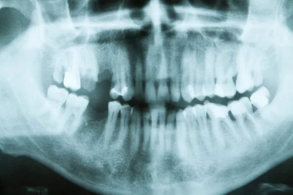 Radiografia dentale — Foto Stock