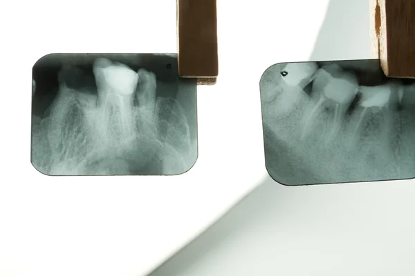 Radiografia dentale — Foto Stock