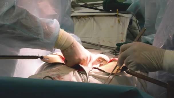 Ομάδα επαγγελματιών ιατρών πολλαπλών φυλών που χειρουργούν στο δωμάτιο του νοσοκομείου — Αρχείο Βίντεο