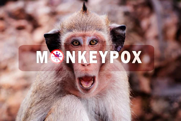 Concepto Brote Monkeypox Varicela Causada Por Virus Varicela Varicela Una — Foto de Stock