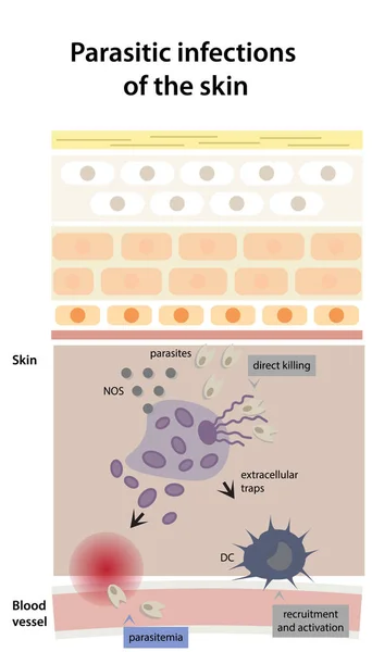 皮膚の寄生虫感染症 寄生虫感染症の開発のスキーム 寄生虫症のプロセス 募集と活性化 — ストックベクタ