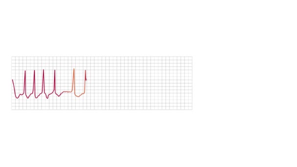 Animated Electrocardiograph Monitor Graph Shows Atrial Fibrillation Abnormality — Stockvideo