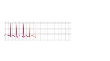 Sinüs taşikardisi anormalliğini gösteren animasyon elektrokardiyografi monitörü grafiği