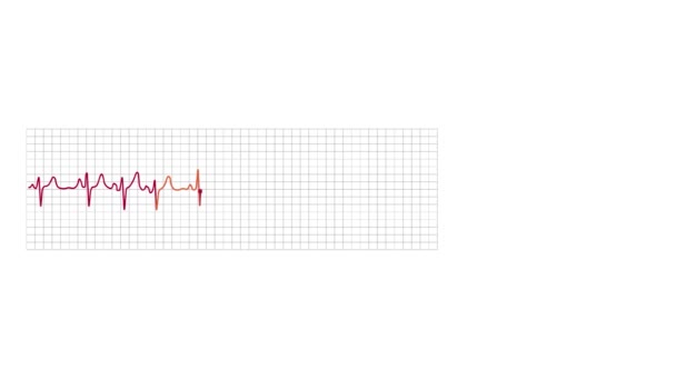 Animasyon Elektrokardiyografi Monitörü Grafiği Sinüs Ritim Bozukluğunu Gösteriyor — Stok video