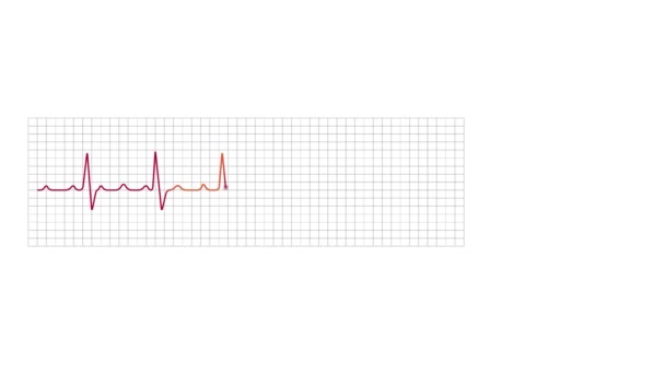 第2次部分ブロック異常を示すアニメーション電気心電図モニターグラフ — ストック動画